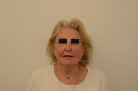 Facelift Before & After Image