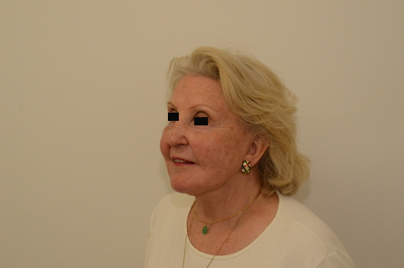 Facelift Before & After Image