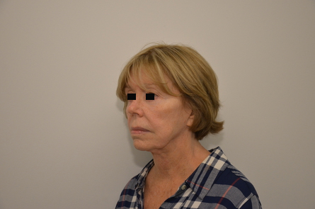 Facelift Before & After Image