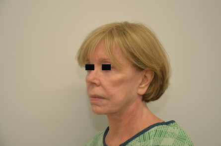 Facelift Before & After Image