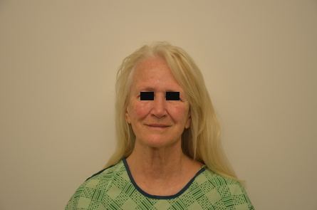 Facelift Before & After Image