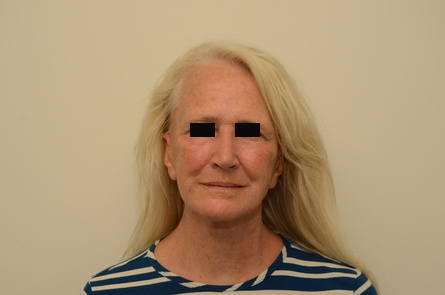 Facelift Before & After Image