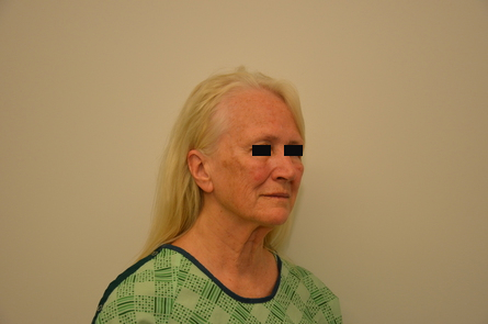 Facelift Before & After Image