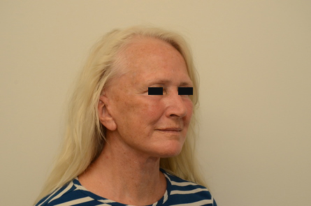 Facelift Before & After Image