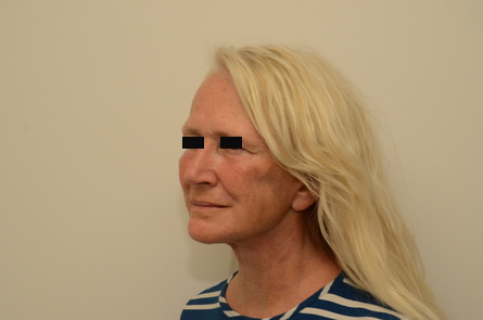 Facelift Before & After Image