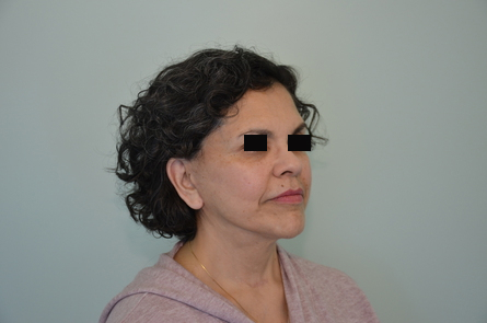 Facelift Before & After Image