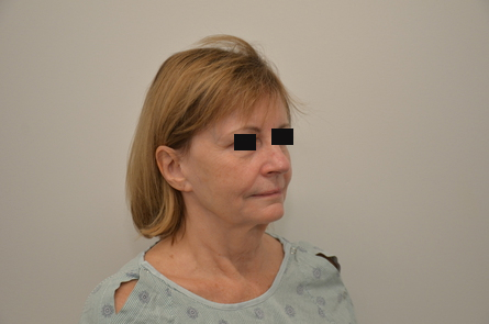 Facelift Before & After Image