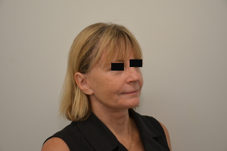 Facelift Before & After Image