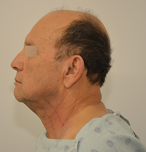 Facelift Before & After Image