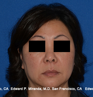 Facelift Before & After Image