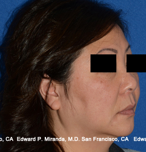 Facelift Before & After Image