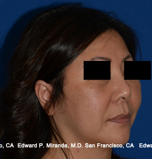 Facelift Before & After Image