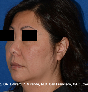 Facelift Before & After Image