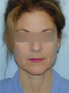 Facelift Before & After Image