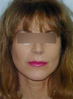 Facelift Before & After Image