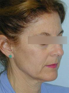 Facelift Before & After Image