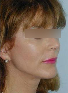 Facelift Before & After Image