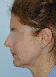 Facelift Before & After Image