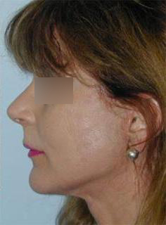 Facelift Before & After Image