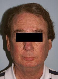 Facelift Before & After Image