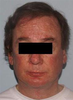 Facelift Before & After Image