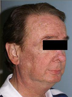 Facelift Before & After Image