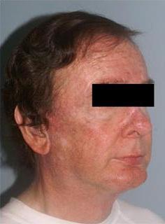 Facelift Before & After Image