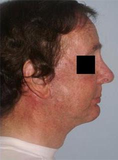 Facelift Before & After Image