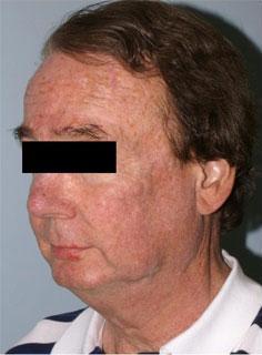 Facelift Before & After Image