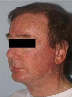 Facelift Before & After Image