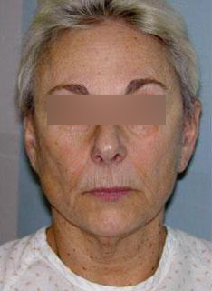 Facelift Before & After Image