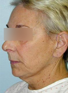 Facelift Before & After Image