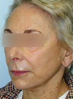 Facelift Before & After Image