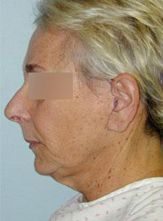 Facelift Before & After Image