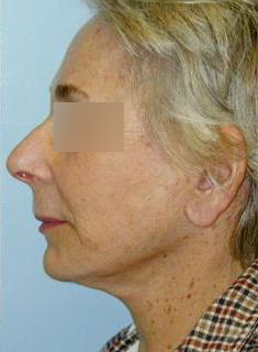 Facelift Before & After Image