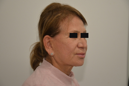 Facelift Before & After Image