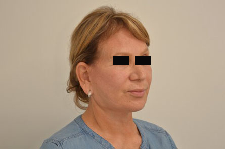 Facelift Before & After Image