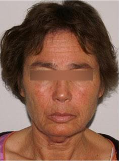 Facelift Before & After Image