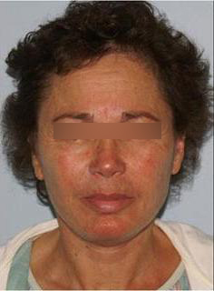 Facelift Before & After Image