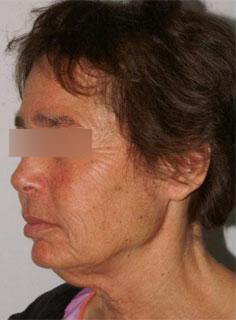 Facelift Before & After Image