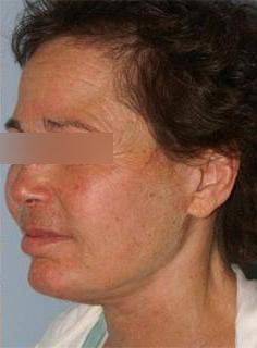 Facelift Before & After Image