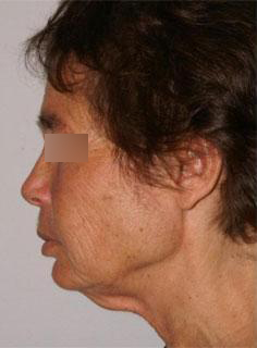 Facelift Before & After Image