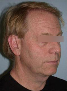 Facelift Before & After Image