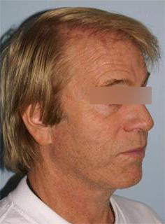 Facelift Before & After Image