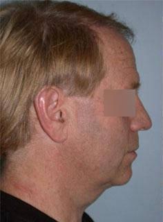 Facelift Before & After Image