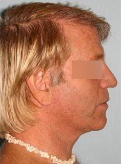 Facelift Before & After Image