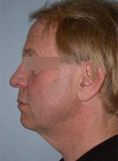 Facelift Before & After Image