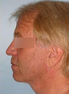 Facelift Before & After Image