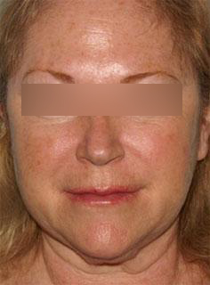 Facelift Before & After Image