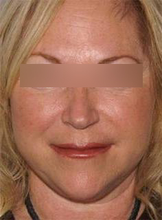 Facelift Before & After Image